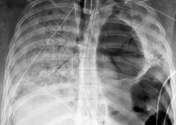 Organización Mundial de la Salud asegura que Ómicron solo afecta la parte superior del cuerpo, no los pulmones
