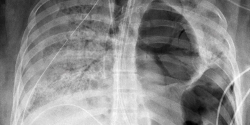 Organización Mundial de la Salud asegura que Ómicron solo afecta la parte superior del cuerpo, no los pulmones