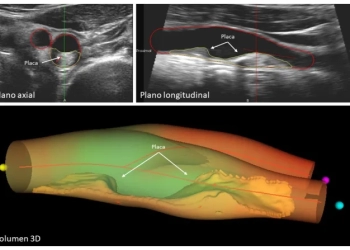 Descubren relación entre progresión de la ateroesclerosis y la mortalidad global