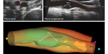 Descubren relación entre progresión de la ateroesclerosis y la mortalidad global